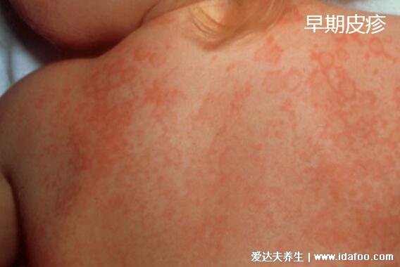 川崎病皮疹什么样图片,初期红疹子遍布全身注意和猩红热区分