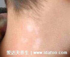 白色痣的图片,其实就是白斑(和白癜风不同)