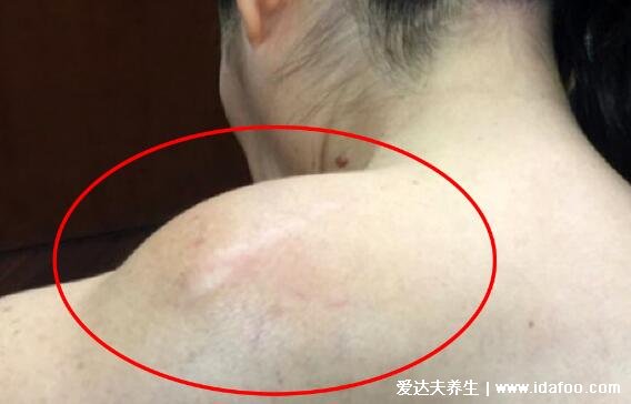 背上长脂肪瘤图片大全,质地柔软的肿块需要手术切除