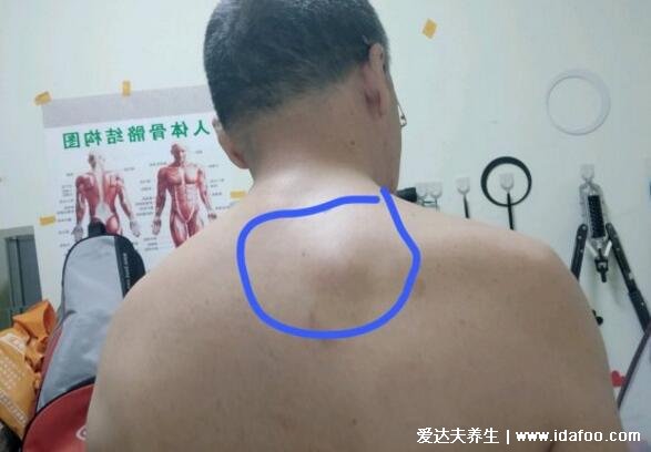背上长脂肪瘤图片大全,质地柔软的肿块需要手术切除