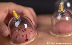 拔罐后多长时间可以洗澡,3小时内不能洗附