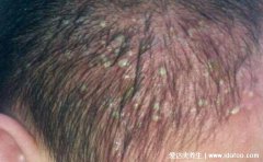 毛囊炎疙瘩怎么消除,硫磺皂洗澡外涂抗生