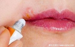 嘴唇上火起泡怎么快速消除，5个小妙招亲测