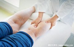 静脉曲张的最快消除方法，5种方法促进血液