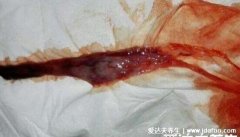 子宫内膜脱落真正图片,和血块一起掉出来