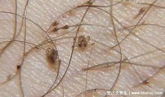 阴虱是什么原因得的，去阴虱子最简单的方