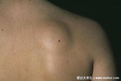 皮瘤长什么样子图片，初期皮下脂肪瘤图片
