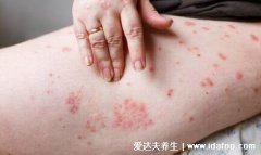 过敏性皮炎图片和症状,诱因过多防不胜防