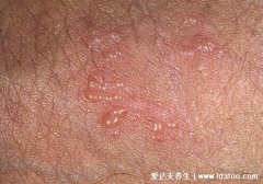 早期生殖疱疹的症状和治疗，长水疱伴随瘙
