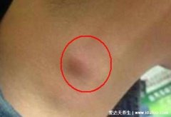 脖子淋巴癌早期图片及症状，能明显摸到质