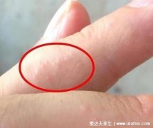 手上长水泡湿疹的图片,密集的小水泡伴随