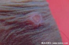 男人刚刚中梅毒图片初期症状图,五大症状