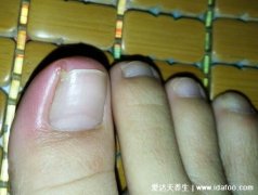 初期甲沟炎图片及症状，指甲变形长进肉里