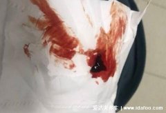 生化妊娠排出蜕膜图片,会有子宫内膜脱落