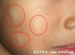 白色痣的图片，其实就是白斑(和白癜风不同