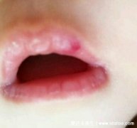 唇部血管瘤初期图片，紫红色质地软的肿瘤