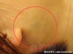 青色血管瘤的症状图片，不痛不痒的青色疙