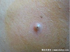 皮脂腺囊肿粉瘤图片及症状,感染后红肿疼