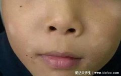 小孩缺维生素脸上白斑图片,还有可能是白