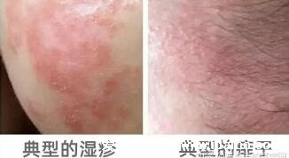 热痱子和湿疹的区别图,湿疹情况比痱子要严重