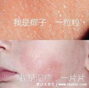 热痱子和湿疹的区别图,湿疹情况比痱子要