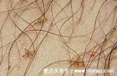 男性下面感染早期症状图片，出现红色斑点