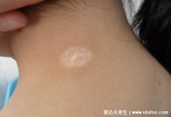 白斑好转的迹象的图片,颜色变淡变模糊出