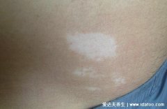 小孩肚子上有块白斑图,有五种可能不一定