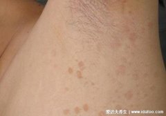 花皮癣早期症状图片,一大片圆形点状的白