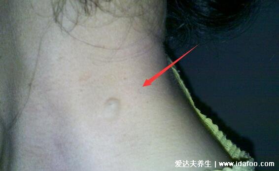 初期皮下脂肪瘤图片及症状,早期的皮下肿块质地柔软有弹性