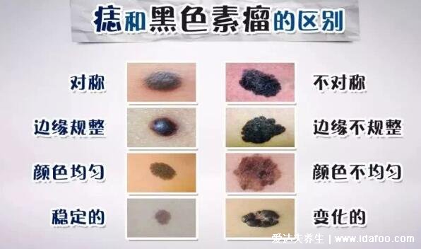 良性黑色素痣图片,警惕发展成恶性黑色素瘤的早期症状