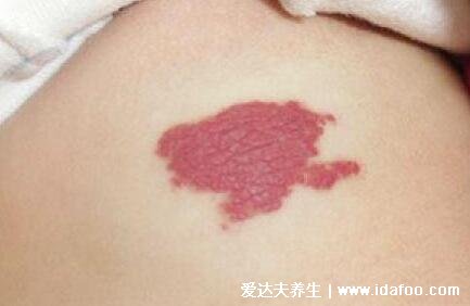 血管瘤长什么样子图片,皮肤上的红色小肿瘤(常见于婴儿身上)