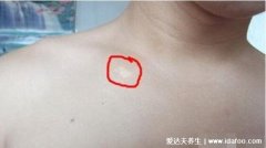 真实轻度白斑早期症状图片,白斑不痒不脱