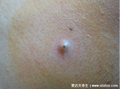 粉瘤早期图片及初期症状,圆形囊肿中央有