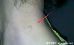 初期皮下脂肪瘤图片及症状，早期的皮下肿