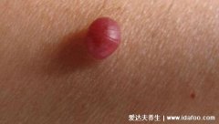 年轻人樱桃状血管瘤图片，身上出现红色痣