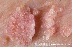 女性长出疣体初期图片，长了白色小米粒就