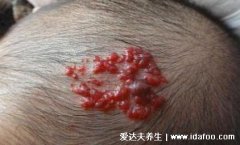 血管瘤长什么样子图片，皮肤上的红色小肿
