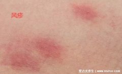 红疹长什么样子的图片,红疹图片初期症状