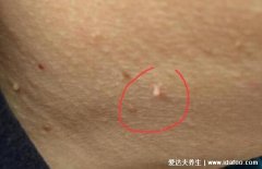 女性脖子丝状疣图片，细软的丝状凸起物会