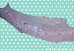 男性假性疣体图片，珍珠状丘疹不是X病不会