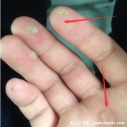 手上和脚底鸡眼初期图片最初的样子，外形