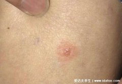 真人蛇盘疮初期图片展示，呈带状分布的小