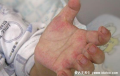 白血病早期出血点图片，多为紫红色针尖