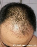 米诺一停头发全没了的原因，停用太快导致