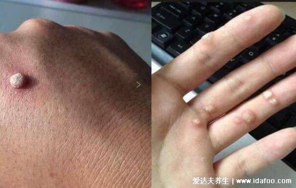 女性脖子丝状疣图片,细软的丝状凸起物会增大传染(hpv导致)