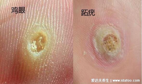 手上和脚底鸡眼初期图片最初的样子,外形像鸡眼针尖至黄豆大小