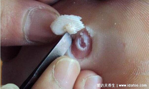 手上和脚底鸡眼初期图片最初的样子,外形像鸡眼针尖至黄豆大小