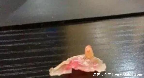 手上和脚底鸡眼初期图片最初的样子,外形像鸡眼针尖至黄豆大小