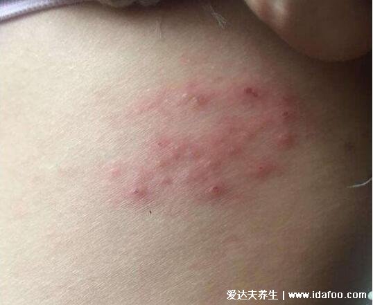 真人蛇盘疮初期图片展示,呈带状分布的小水疱有剧烈神经痛